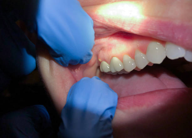 Best Emergency Dental Care for Broken or Chipped Teeth in Merrydale, LA